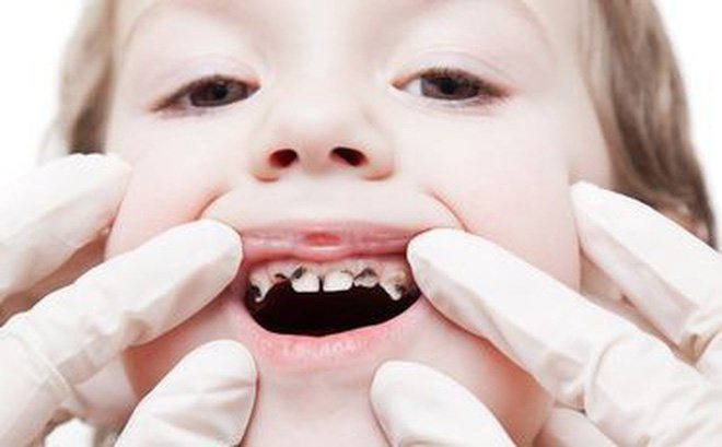 Tình trạng sâu răng sữa ở trẻ dưới 5 tuổi một phần là do thói quen của người lớn