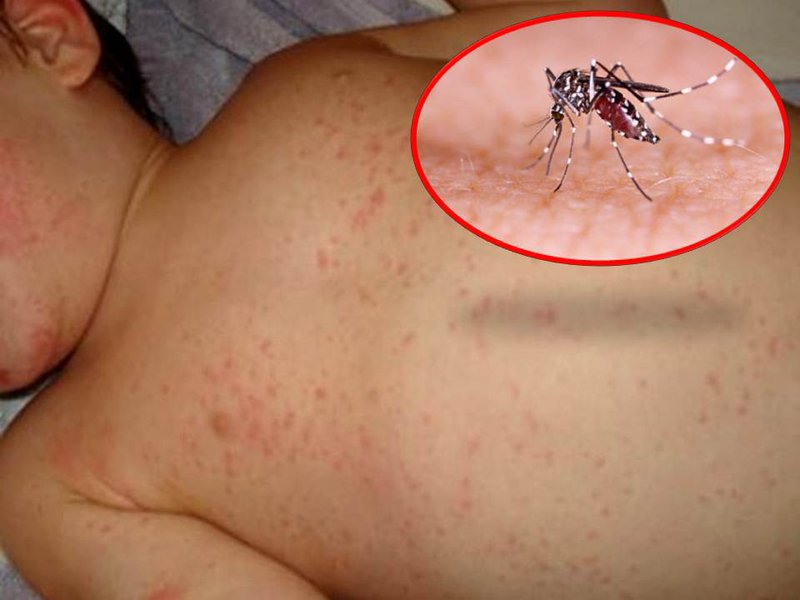 Phân biệt sốt do sốt xuất huyết và sốt do các bệnh lý khác