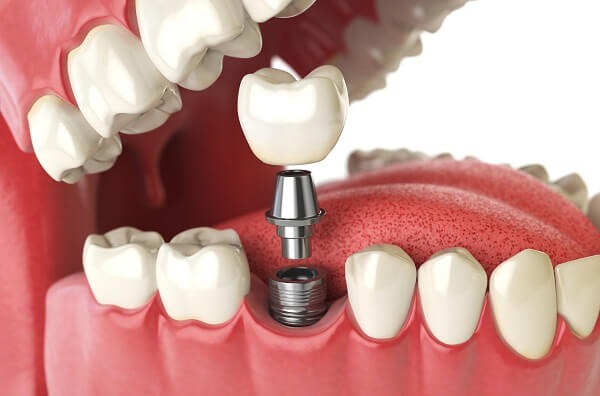 Công nghệ từ tính trong cấy răng implant