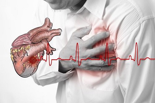 Nhận thức sớm về thiếu máu cục bộ cơ tim