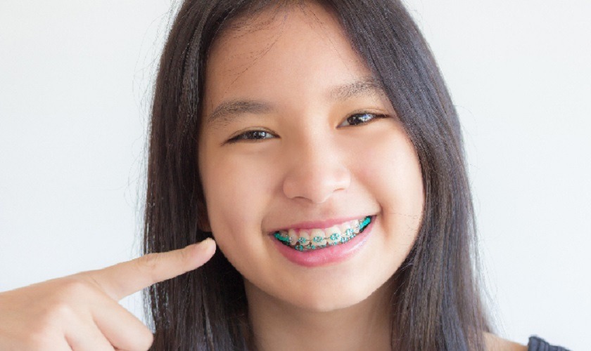 Phương pháp phù hợp để niềng răng cho trẻ