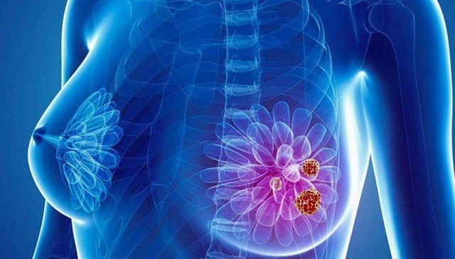 Những tiêu chuẩn trong chẩn đoán và điều trị ung thư vú